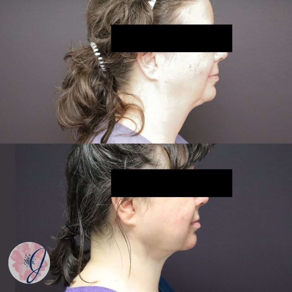 Deep Necklift, Vaser Liposuction + Renuvion to Neck