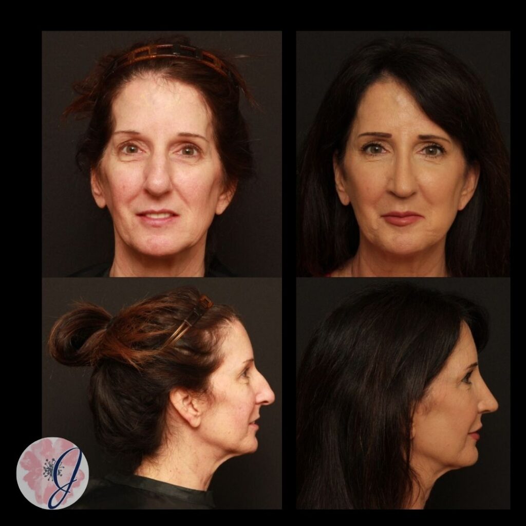 Rhinoplasty, Septoplasty, Temporal Implants, Fat Transfer to Face