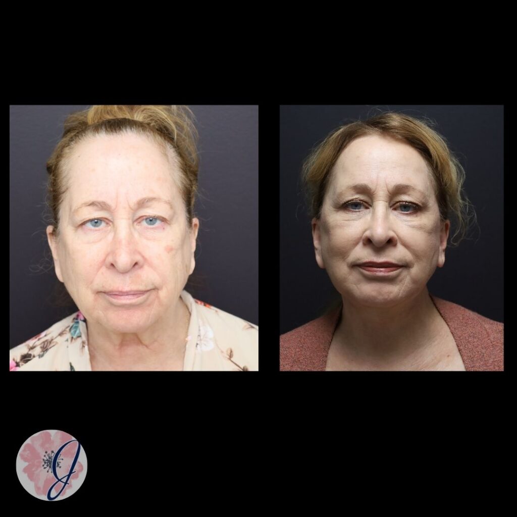 Facelift, Necklift, Endoscopic Brow Lift