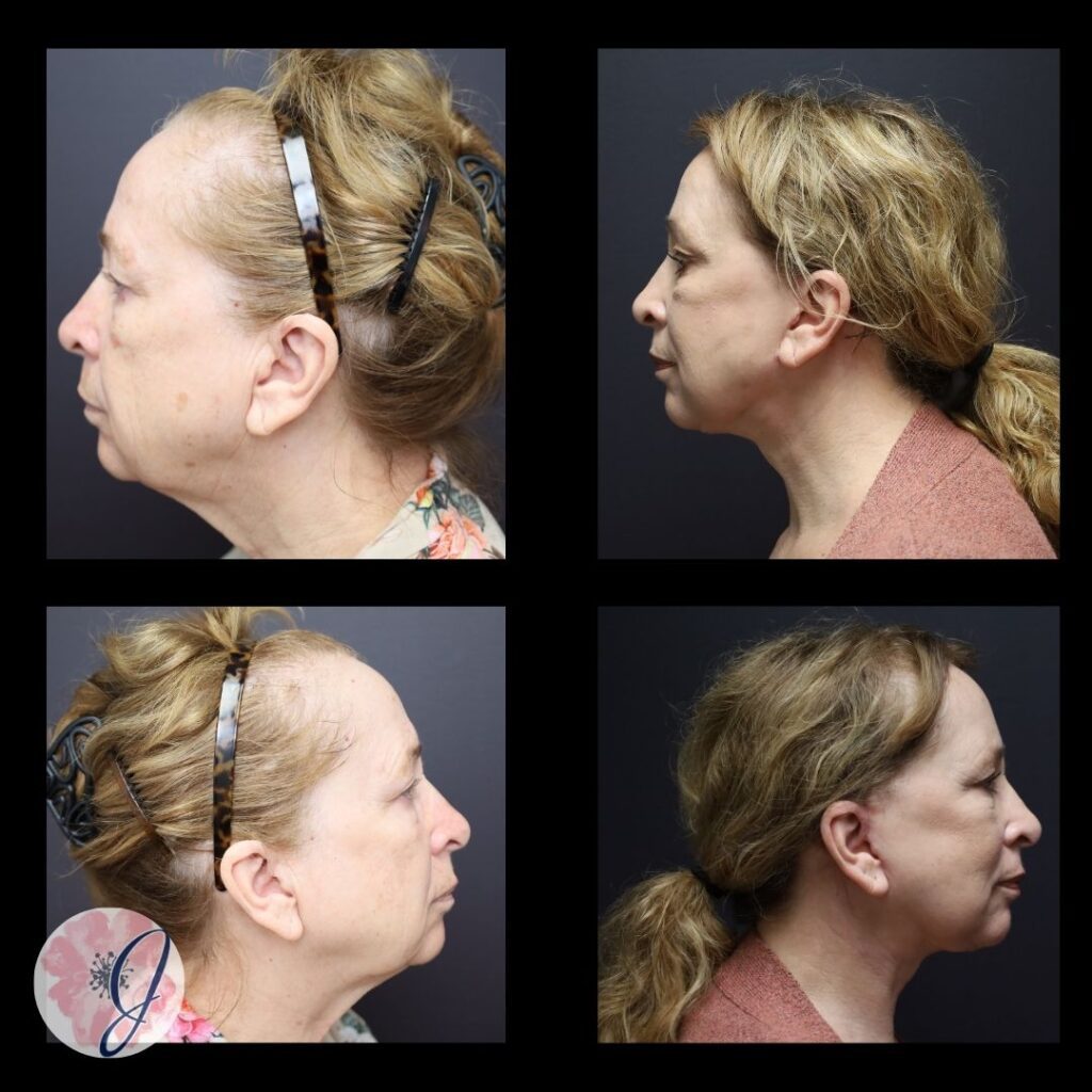 Facelift, Necklift, Endoscopic Brow Lift