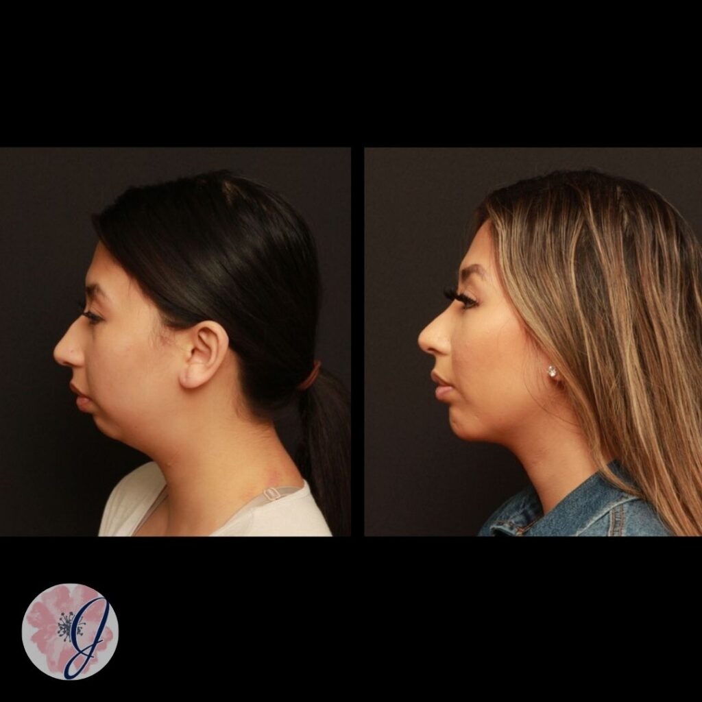 Rhinoplasty, Chin Implant