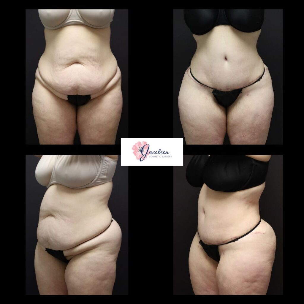 Extended Abdominoplasty + Liposuction 360: Vaser Liposuction to Abdomen and Flanks, Back + Renuvion to Flanks/Back