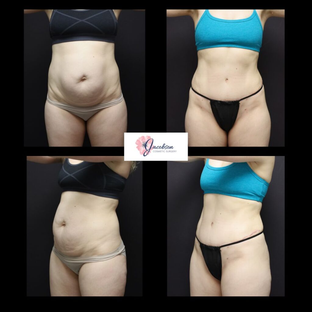 Abdominoplasty + Vaser Liposuction to Abdomen and Flanks
