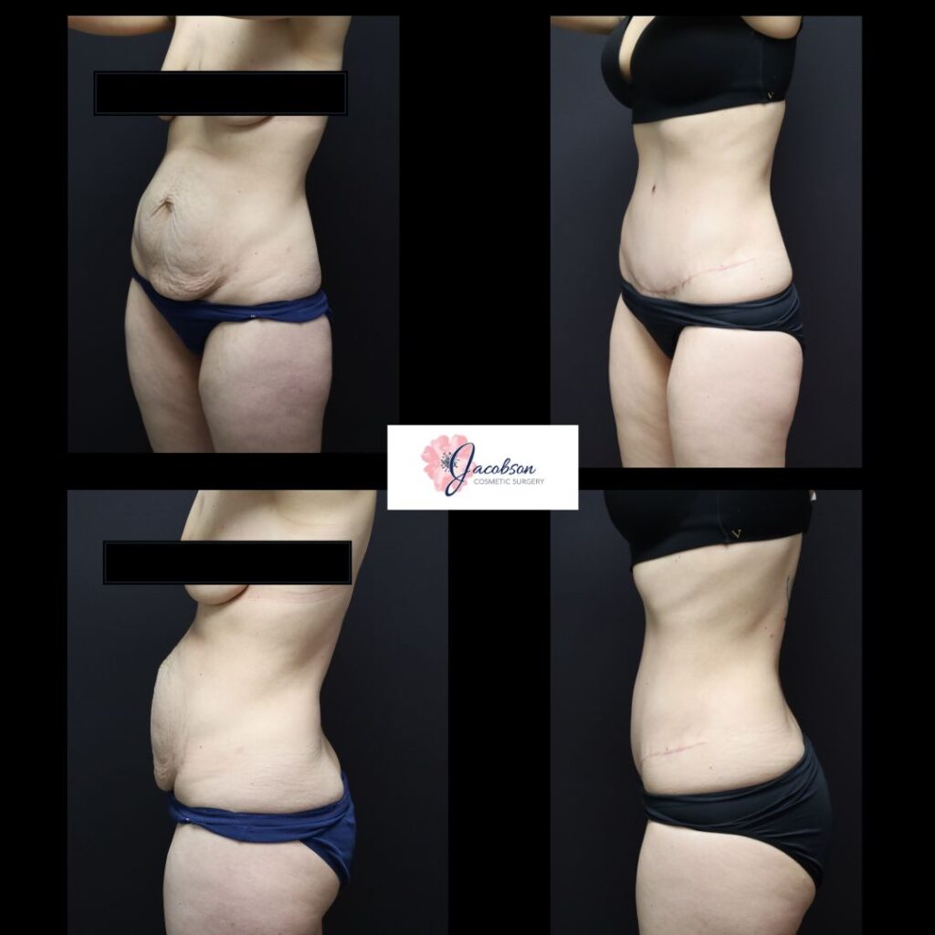 Abdominoplasty + Vaser Liposuction to Abdomen and Flanks