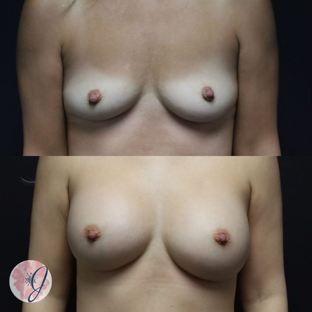 Breast Augmentation with Submuscular Silicone Implants