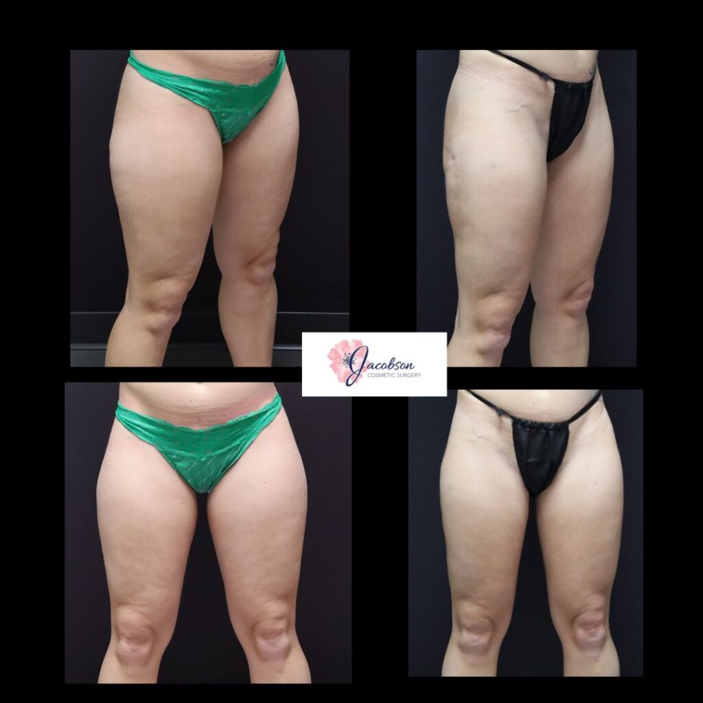 Vaser Liposuction + Renuvion to Medial & Posterior Thighs