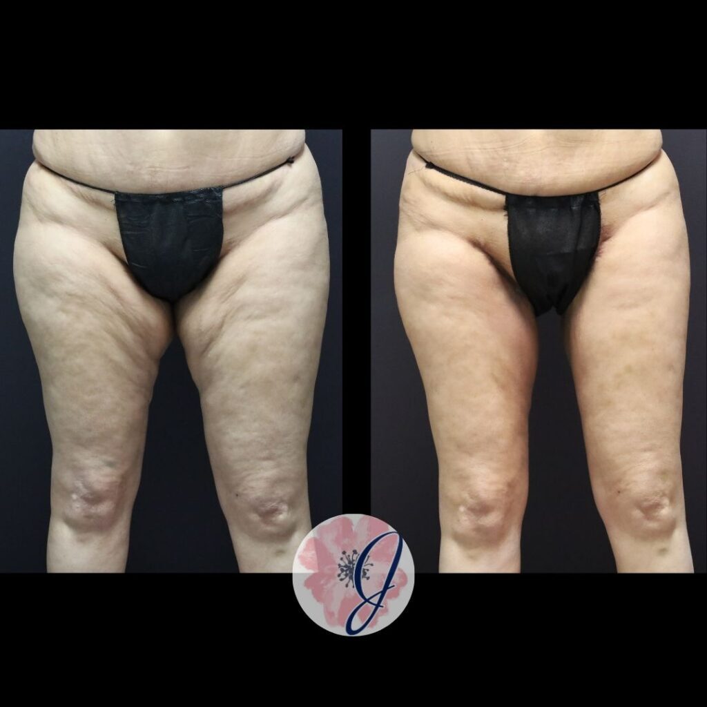 Medial Thigh Lift