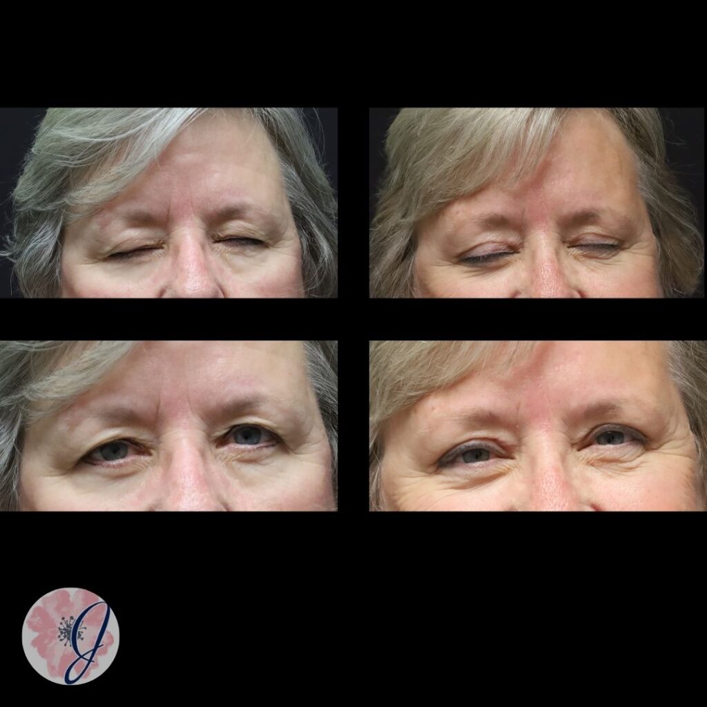 Endoscopic Brow Lift + Upper Blepharoplasty