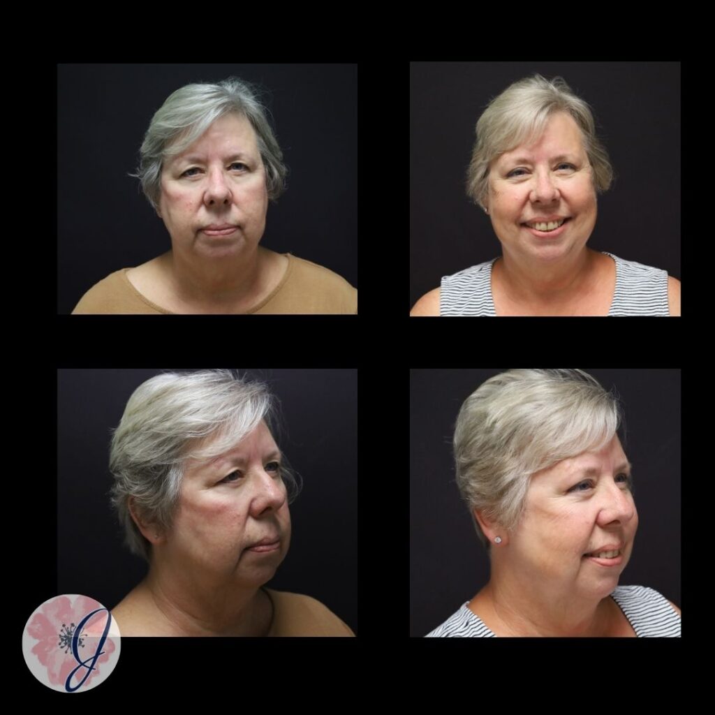 Endoscopic Brow Lift + Upper Blepharoplasty