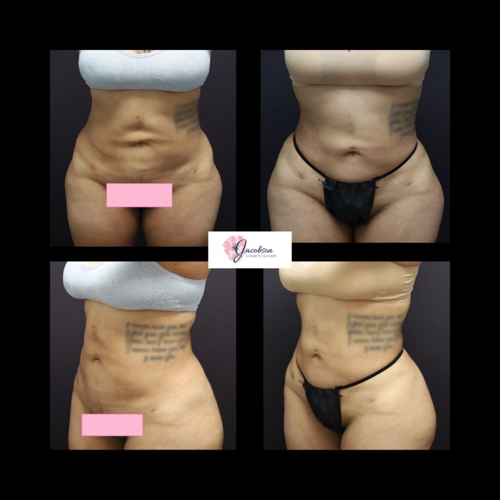 Vaser Liposuction + Renuvion to Abdomen, Flanks