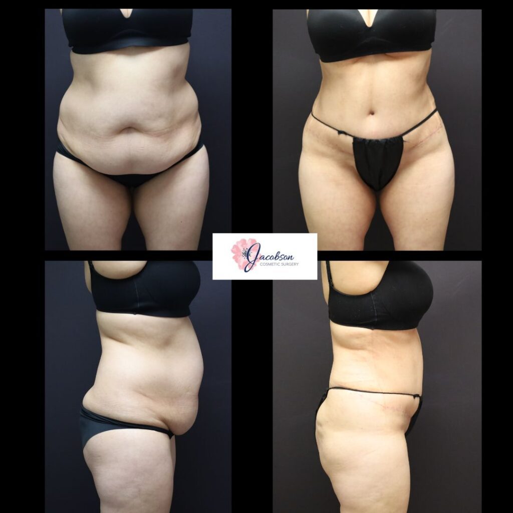 Abdominoplasty + Vaser Liposuction to Abdomen and Flanks
