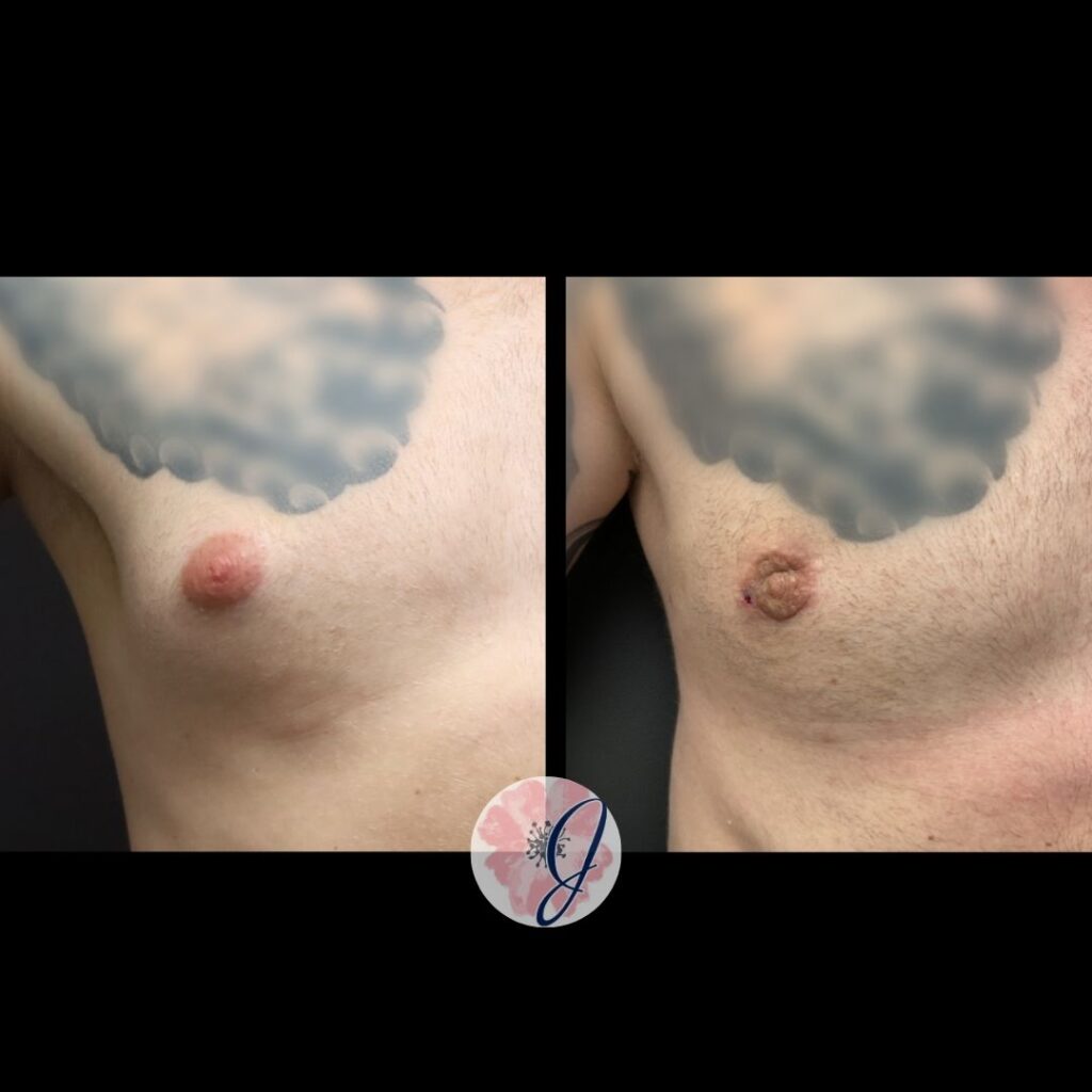 Gynecomastia (Male Breast Tissue) Removal