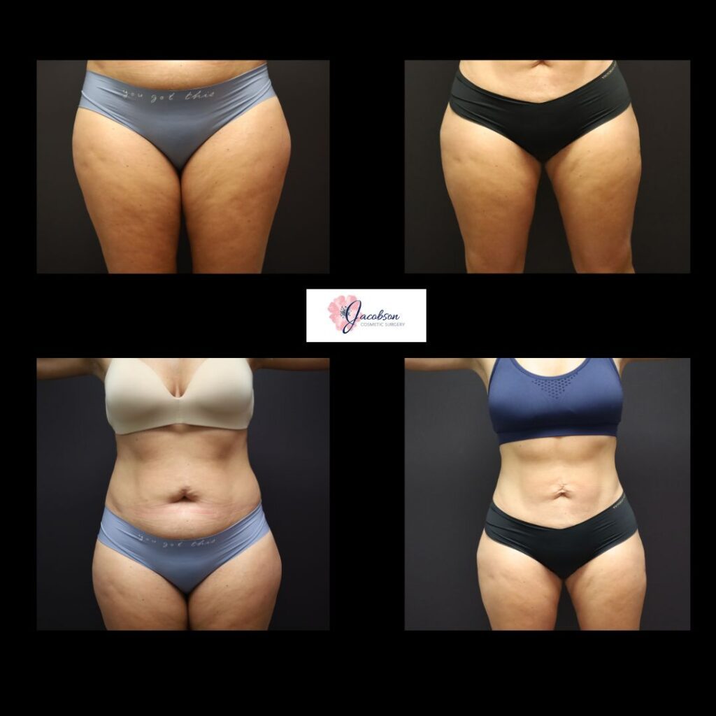 Vaser Liposuction + Renuvion to Abdomen, Flanks, Inner and Outer Thighs
