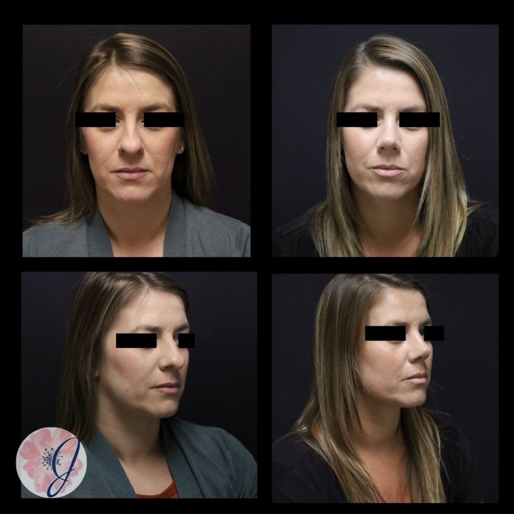 Rhinoplasty