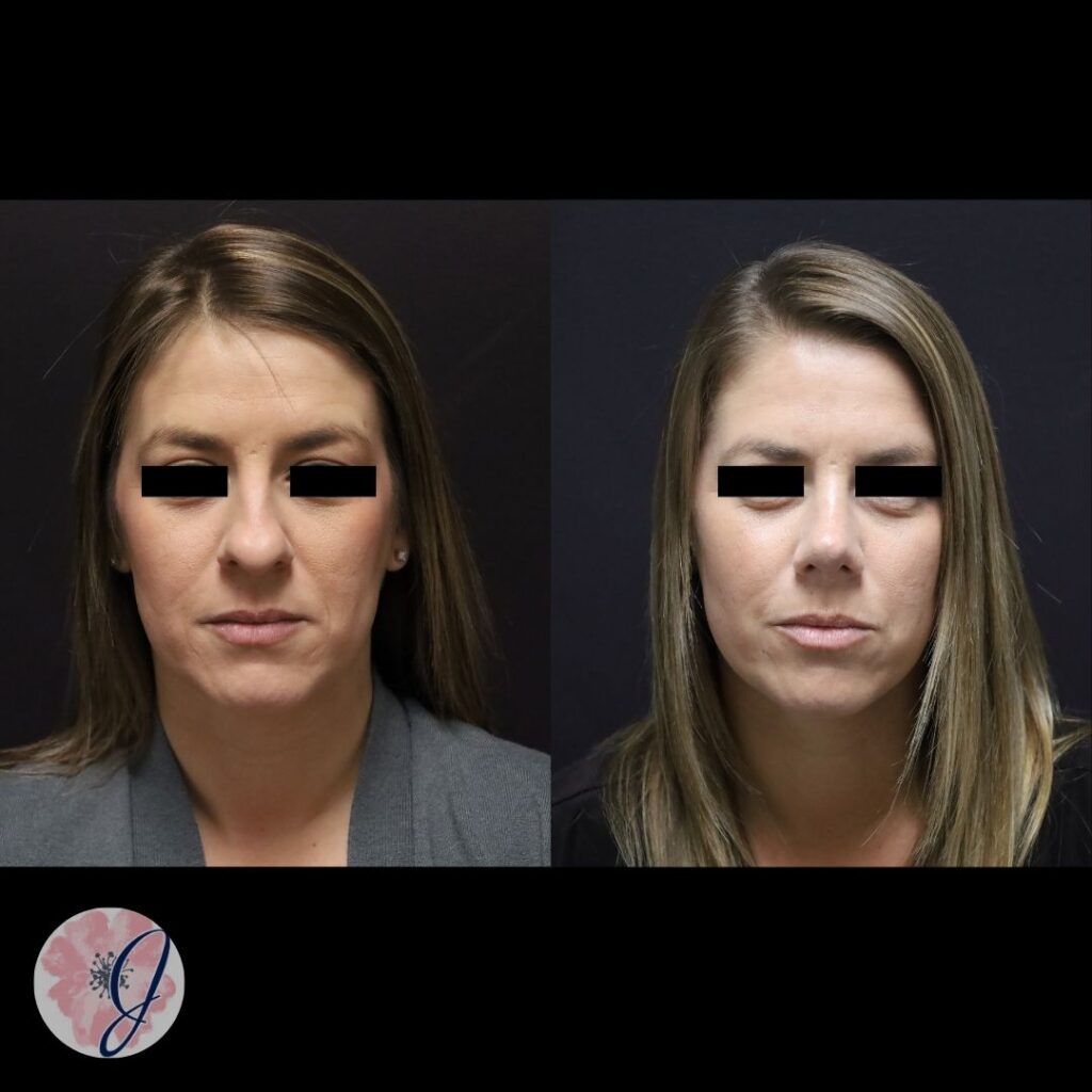 Rhinoplasty
