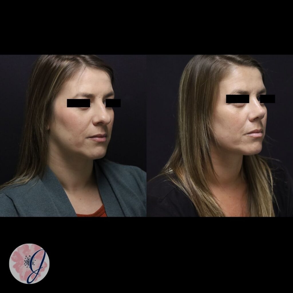 Rhinoplasty