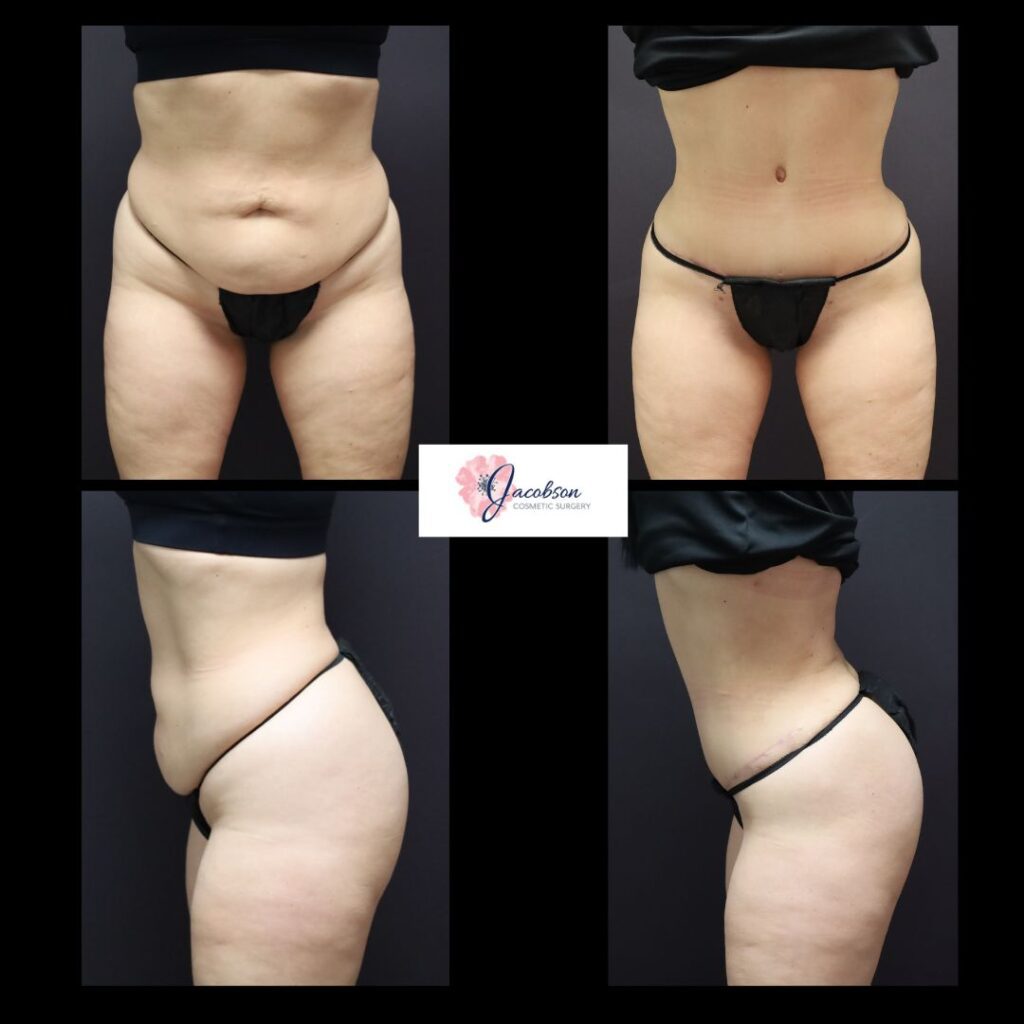 Abdominoplasty + Liposuction 360: Vaser Liposuction to Abdomen and Flanks, Back + Renuvion to Flanks/Back