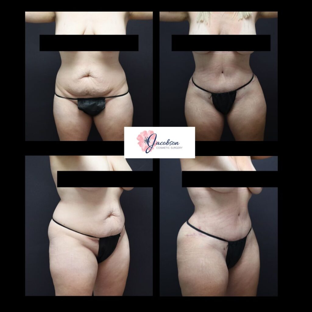 Abdominoplasty + Liposuction 360: Vaser Liposuction to Abdomen and Flanks, Back + Renuvion to Flanks/Back