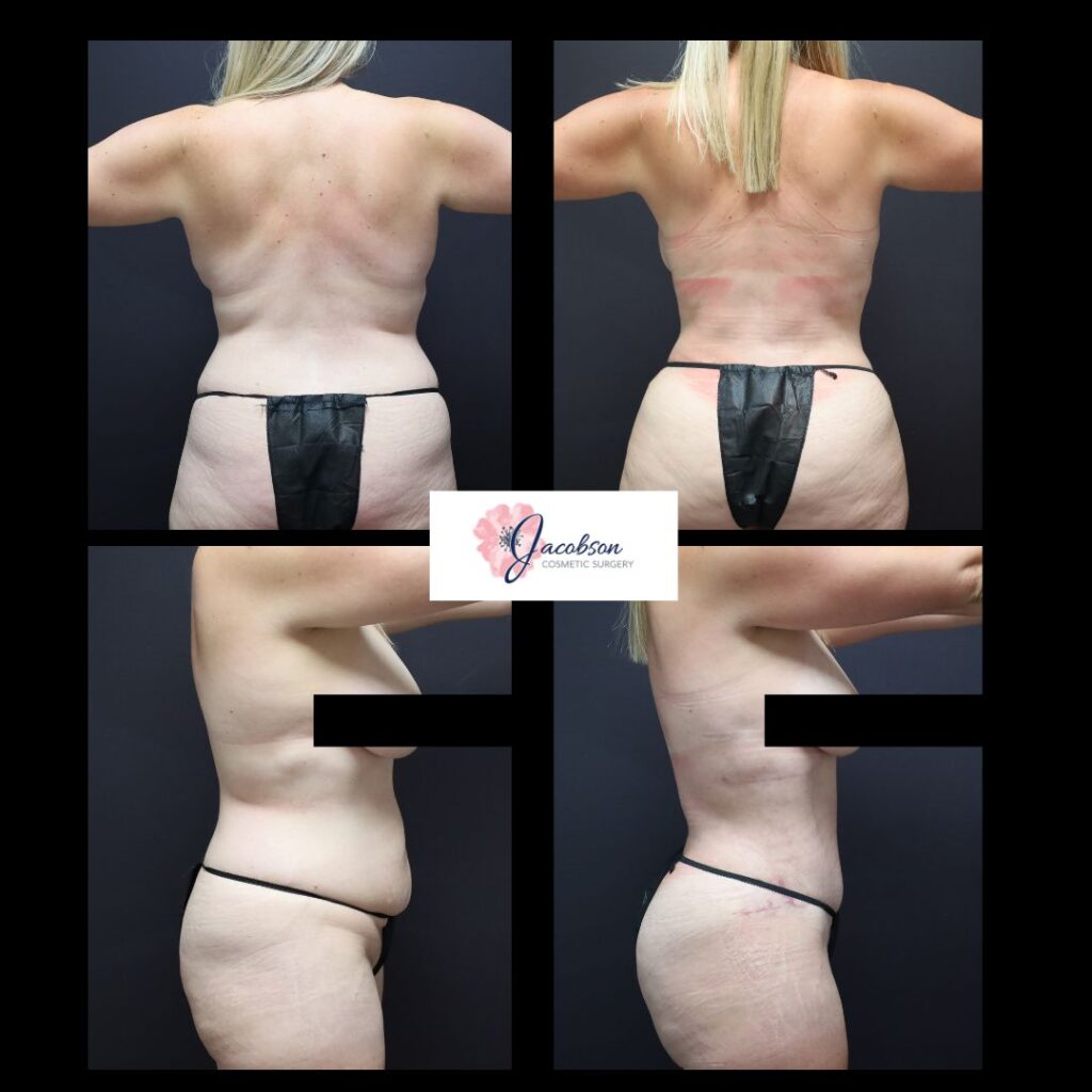 Abdominoplasty + Liposuction 360: Vaser Liposuction to Abdomen and Flanks, Back + Renuvion to Flanks/Back