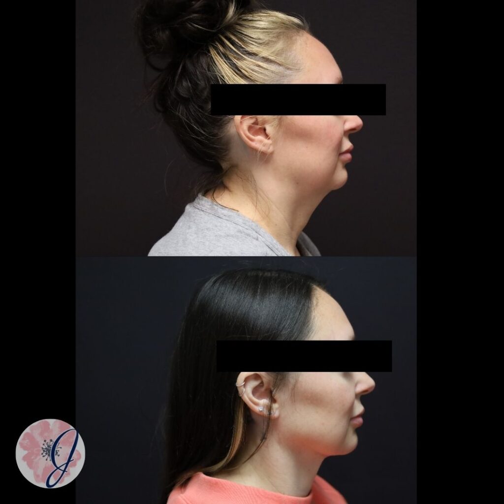 Neck Lift + Vaser Liposuction & Renuvion to Neck