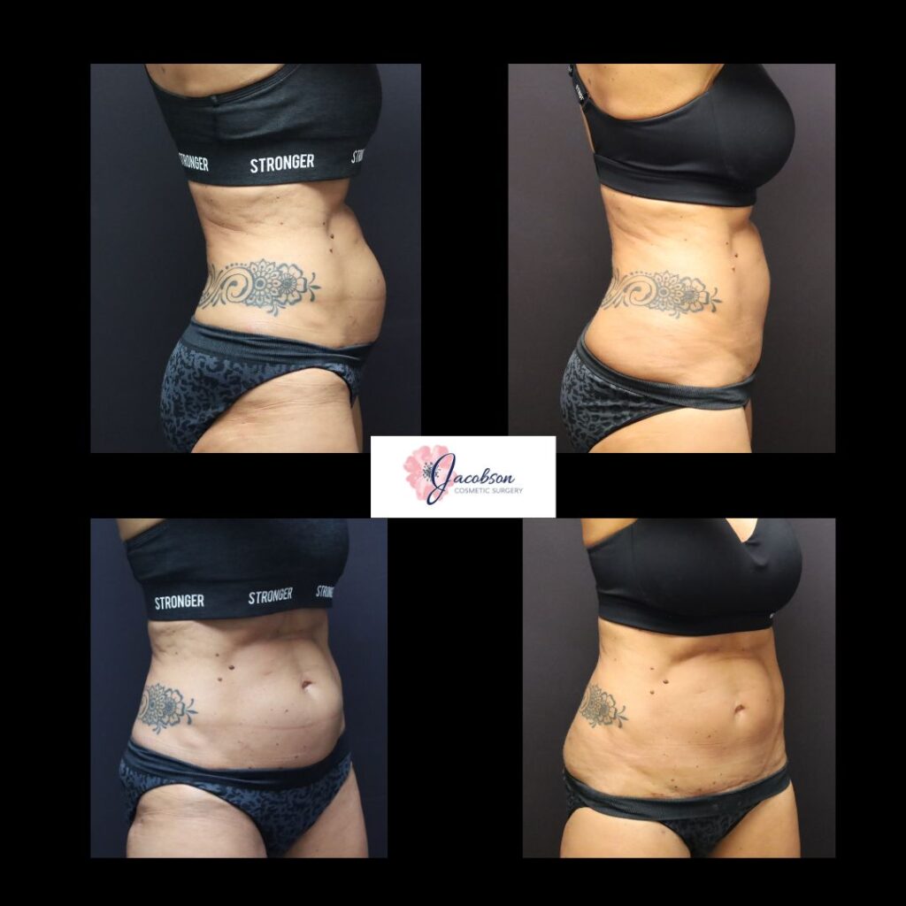 Mini Abdominoplasty
