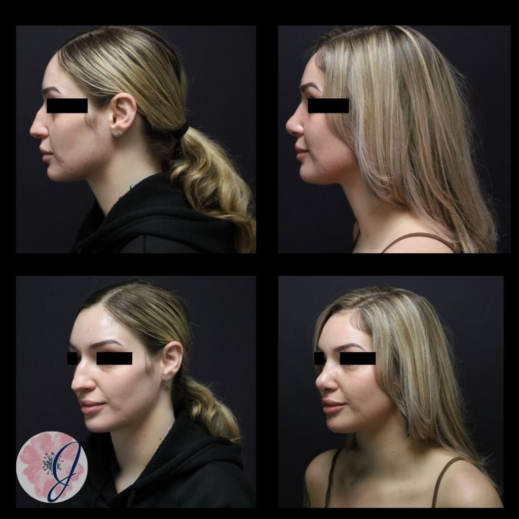 Rhinoplasty