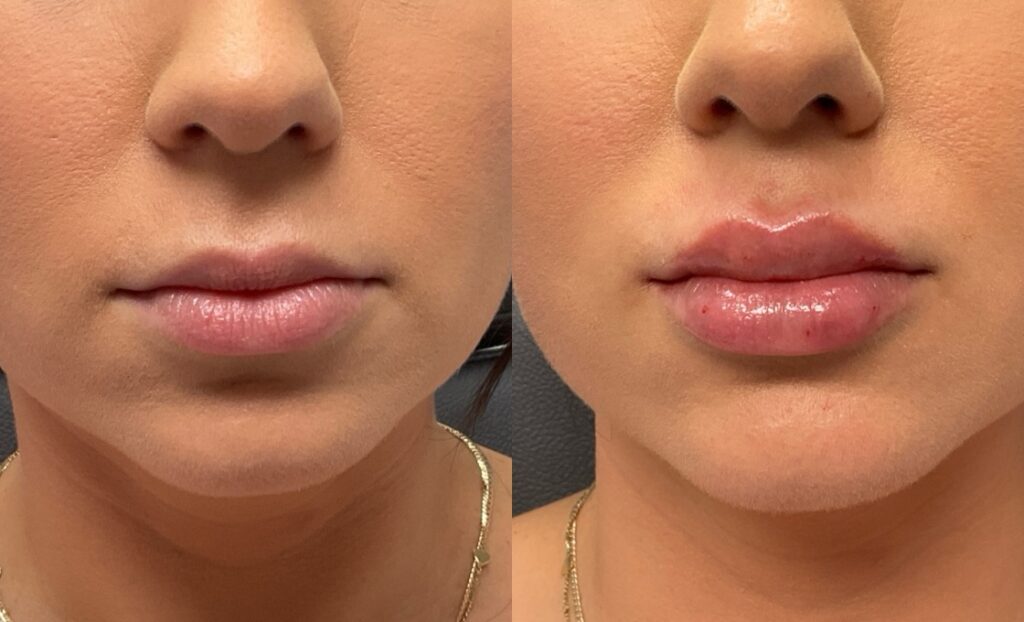 1mL of Juvederm Volbella to lips 1mL of Juvederm Volbella to lips