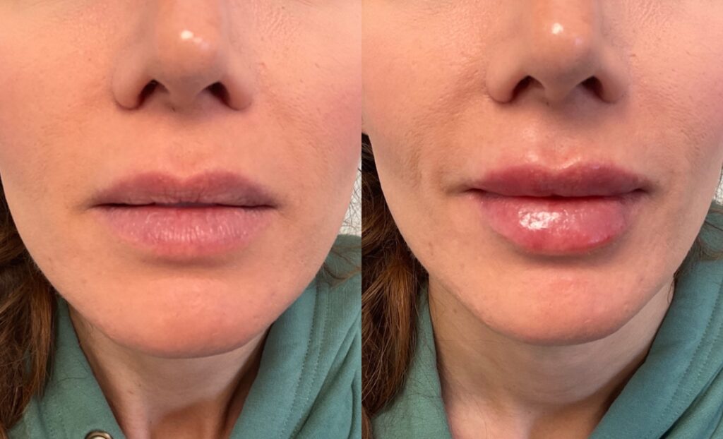 1mL of Juvederm Volbella to lips 1mL of Juvederm Volbella to lips