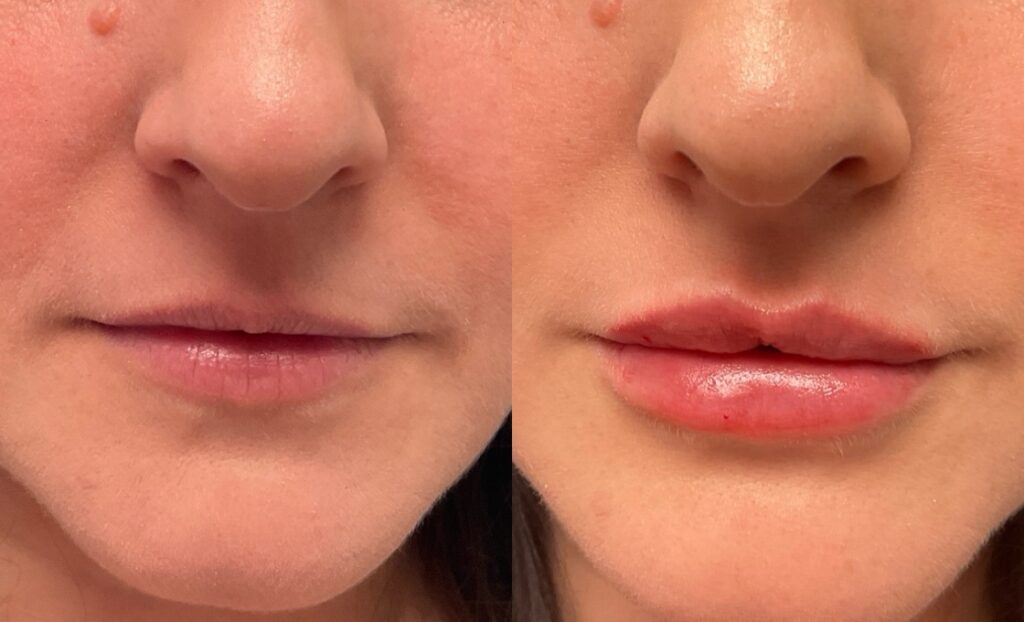 1mL of Juvederm Volbella to lips 1mL of Juvederm Volbella to lips