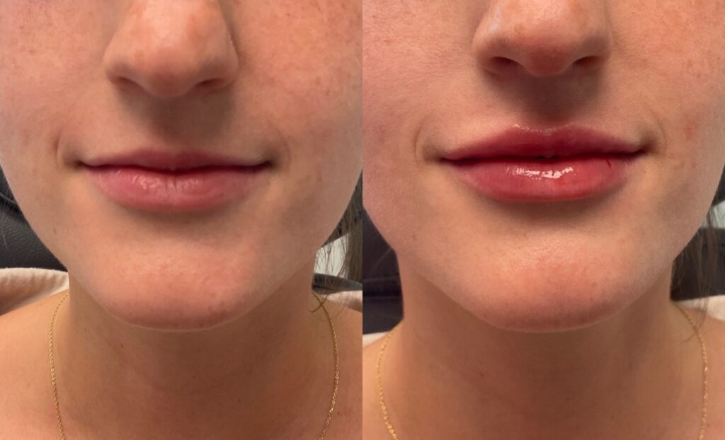 0.55mL of Juvederm Volbella to lips 0.55mL of Juvederm Volbella to lips