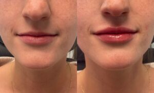 0.55mL of Juvederm Volbella to lips 0.55mL of Juvederm Volbella to lips