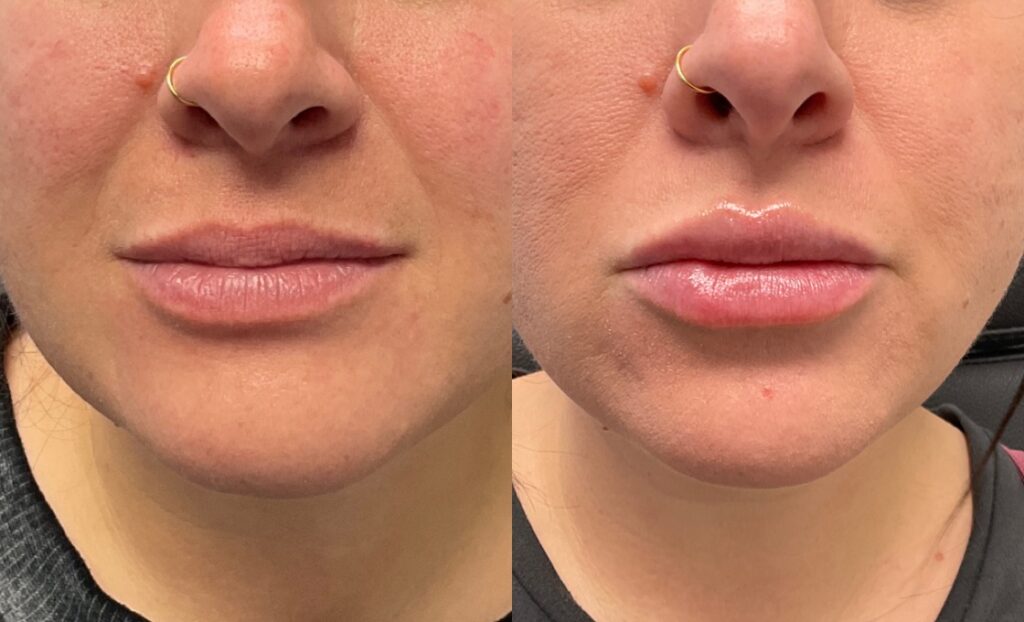 1mL of Juvederm Volbella to lips 1mL of Juvederm Volbella to lips