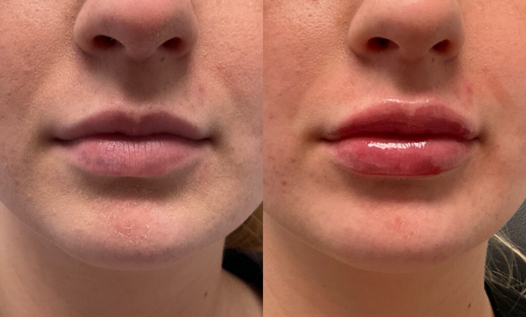 1mL Volbella To Lips