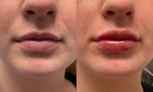 1mL Volbella To Lips