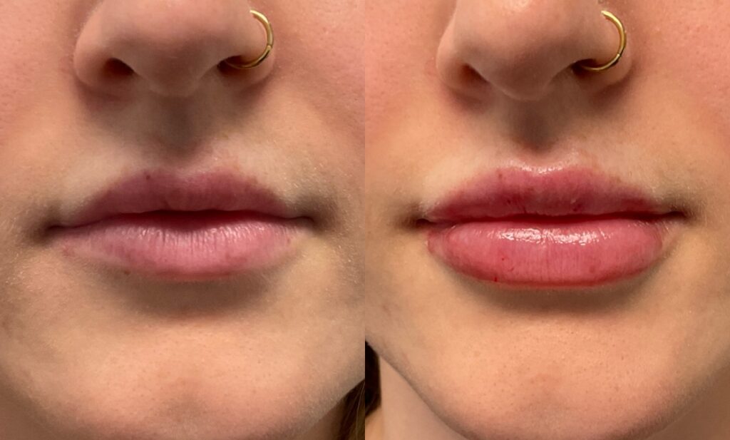 1mL Volbella To Lips