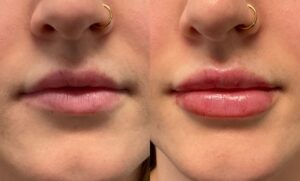 1mL Volbella To Lips