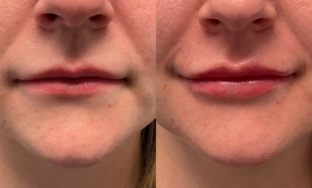 1mL Juvederm Ultra To Lips
