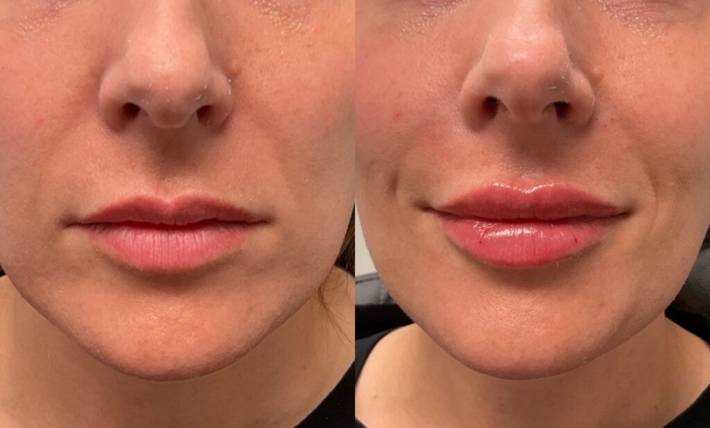 0.55mL Volbella to Lips + 1mL Voluma to Nasolabial Folds