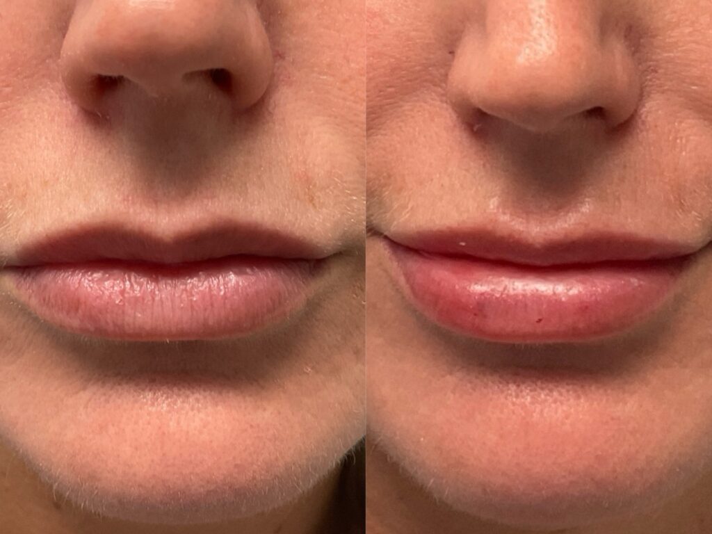 1mL Volbella To Lips