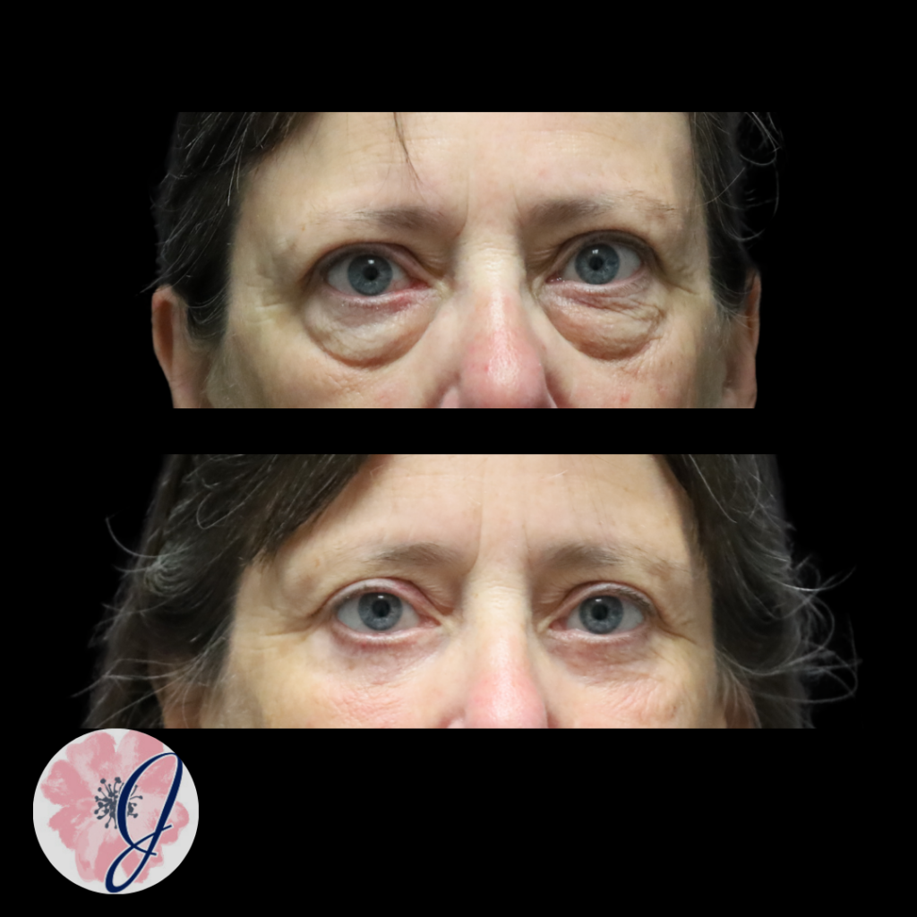 Lower Blepharoplasty (Transconjunctival) + Fat Transfer + Canthopexy