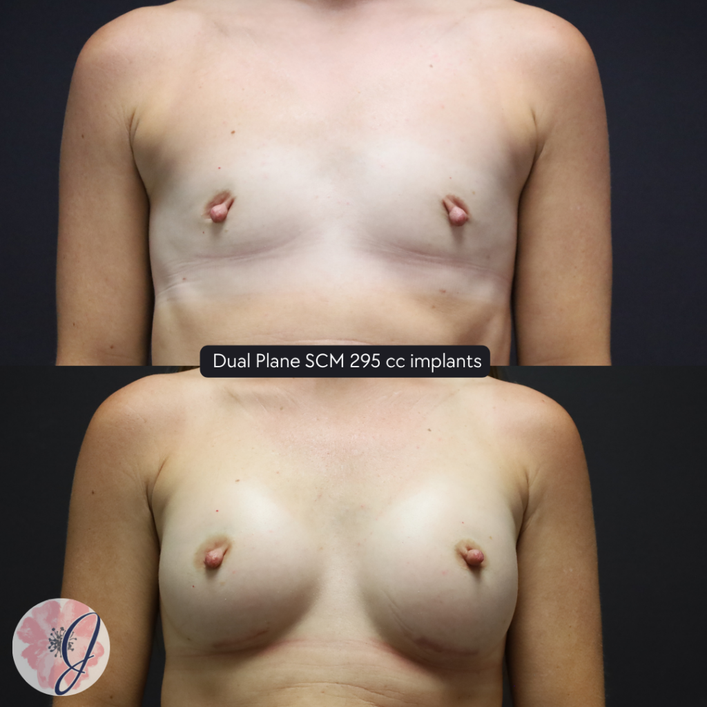 Breast Augmentation with Dual Plane Silicone Implants