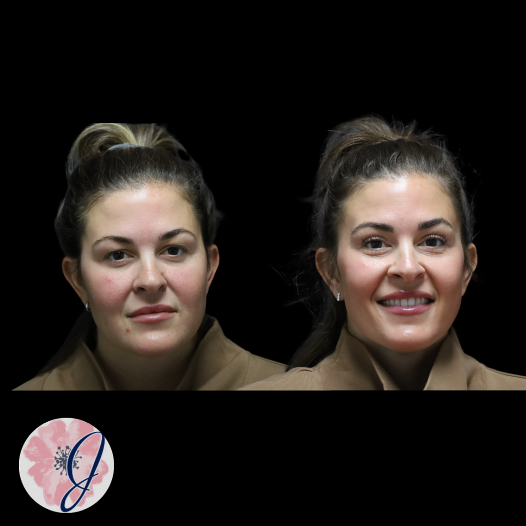 Upper Blepharoplasty (In-Office)