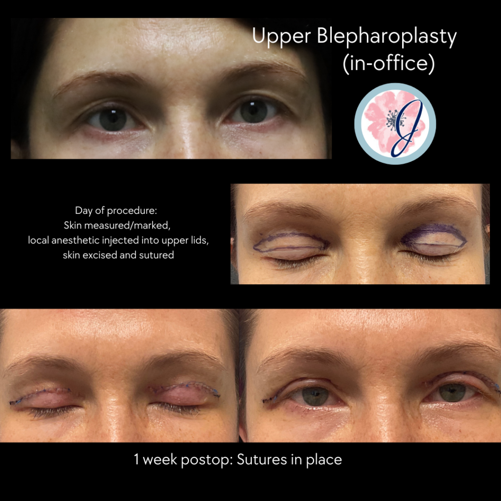 Upper Blepharoplasty (In-Office)