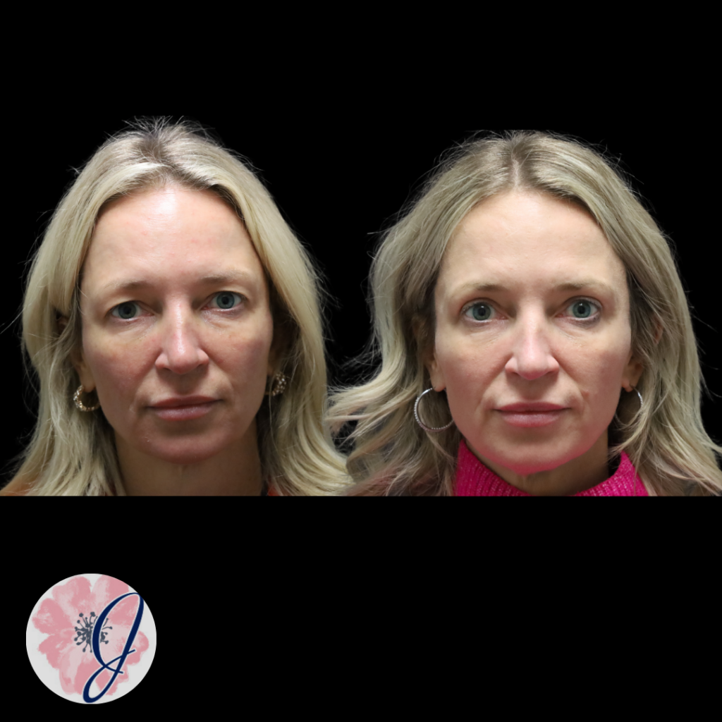 Upper Blepharoplasty (In-Office)