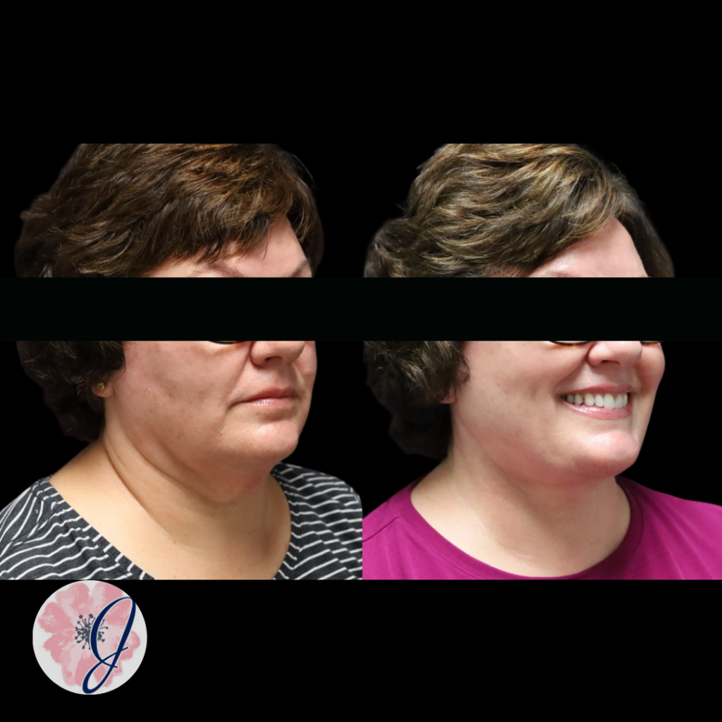 Deep Plane Neck Lift + VASER Liposuction to the Neck