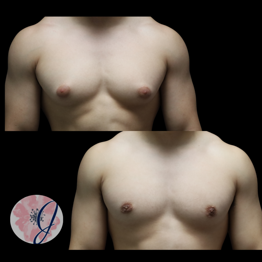 Gynecomastia (Male Breast Tissue) Removal + VASER Lipo to Chest