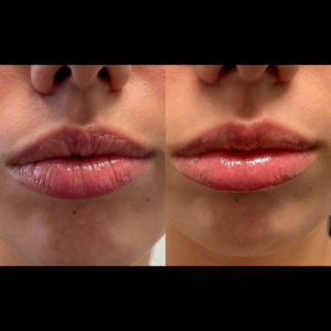 1mL Juvederm Ultra To Lips