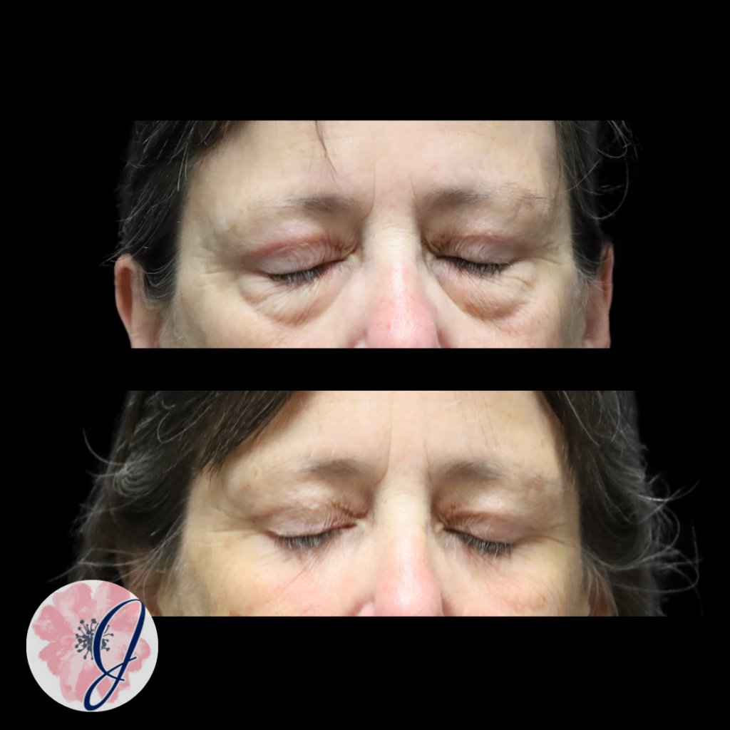 Lower Blepharoplasty (Transconjunctival) + Fat Transfer + Canthopexy