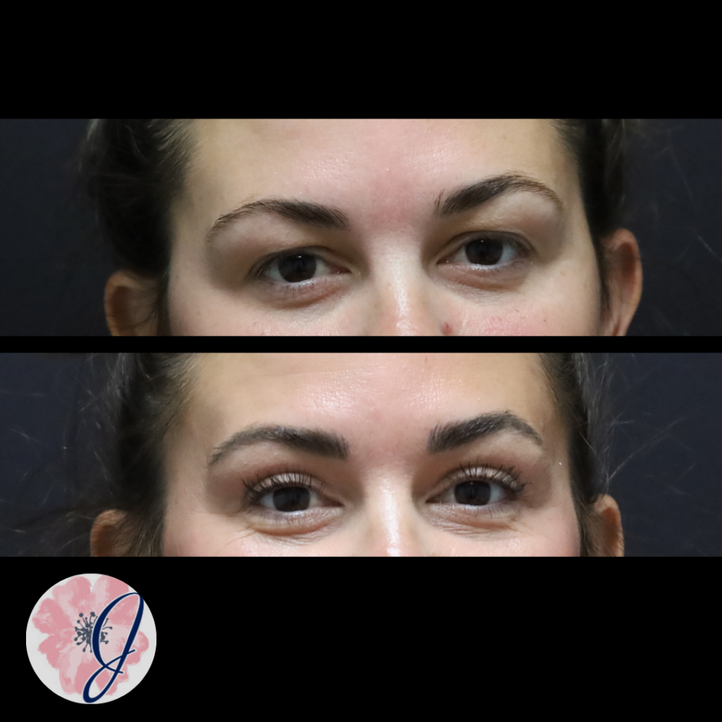 Upper Blepharoplasty (In-Office)