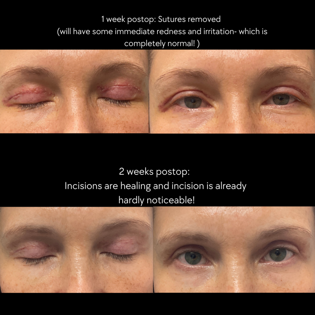 Upper Blepharoplasty (In-Office)